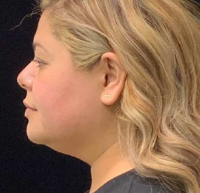 result after CellSound treatments