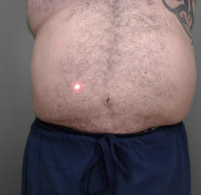 A man's hairy torso with a tattoo, navy shorts, and a red laser dot on the lower abdomen near the navel.