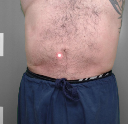 result after CellSound treatments