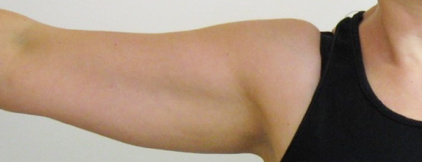 result after CellSound treatments