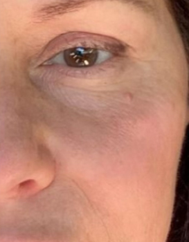 result after NeoGen PSR treatments