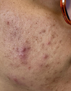 Close-up of a person's cheek with acne, red blemishes and scarring near the frame of eyeglasses.