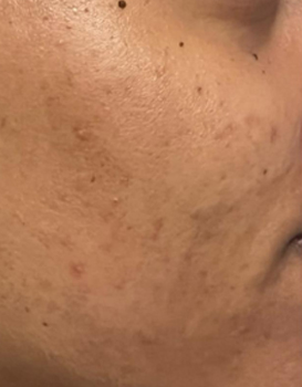 result after NeoGen PSR treatments